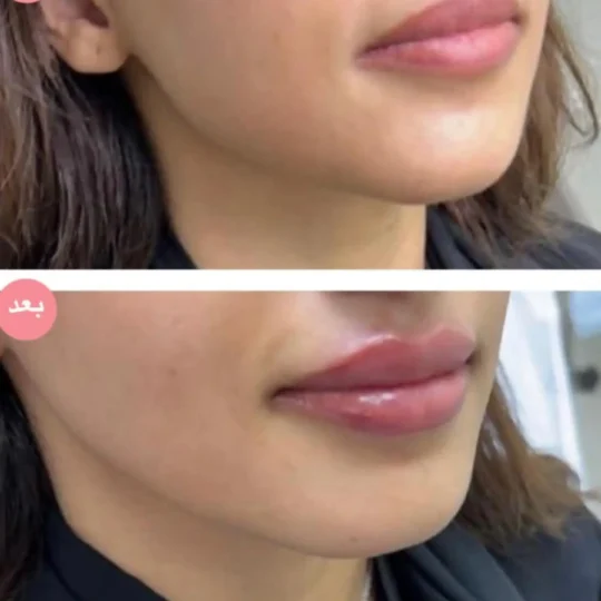 فيلر الشفايف قبل وبعد 1