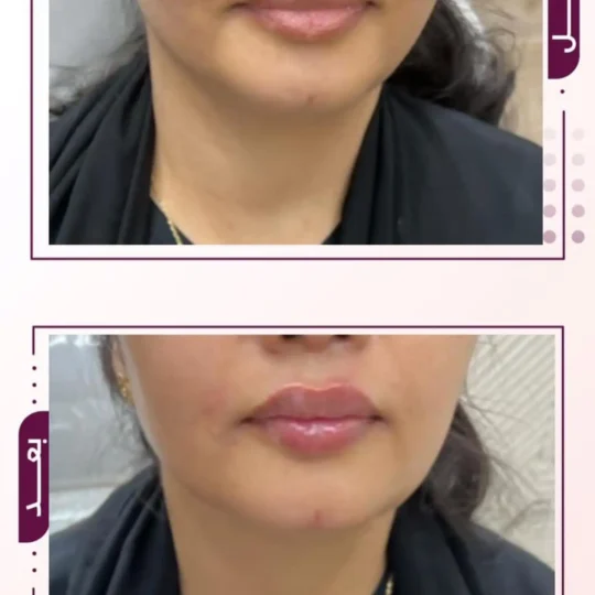 فيلر الشفايف قبل وبعد 6