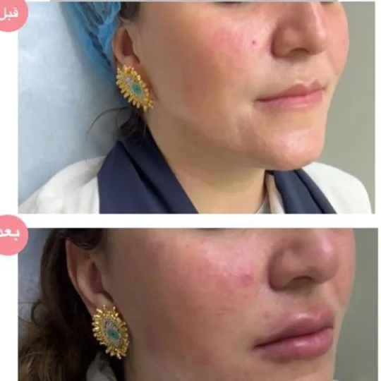 فيلر الشفايف والانف وخط الفك