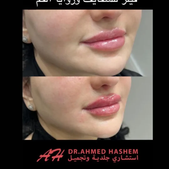 فيلر الشفايف وزوايا الفم