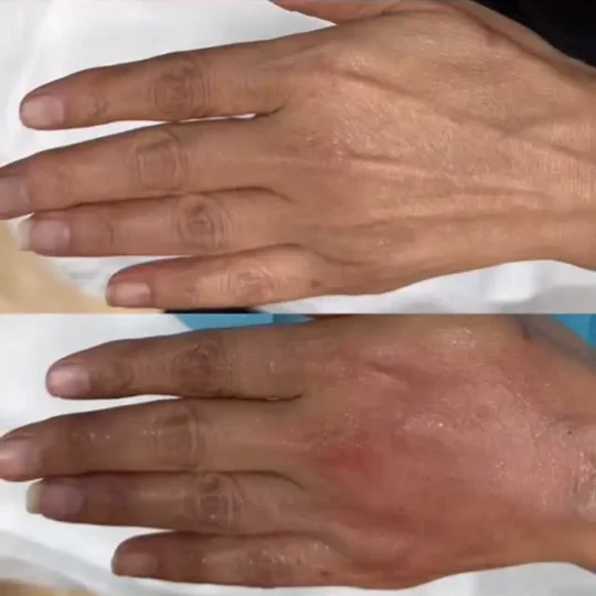 فيلر اليدين قبل وبعد