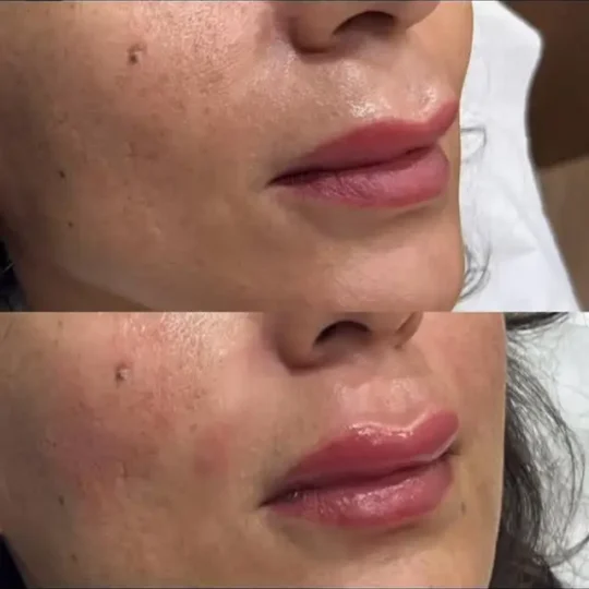 فيلر بتكنيك قلب الشفايف العلوية