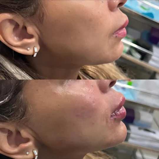 فيلر تحديد خط الفك وإبراز الذقن