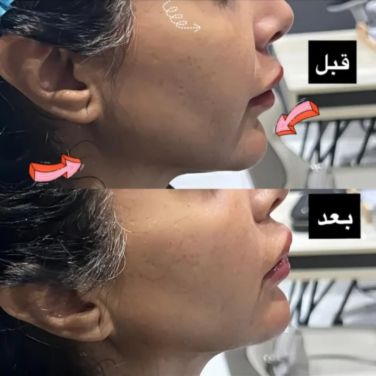 فيلر تحديد خط الفك قبل وبعد