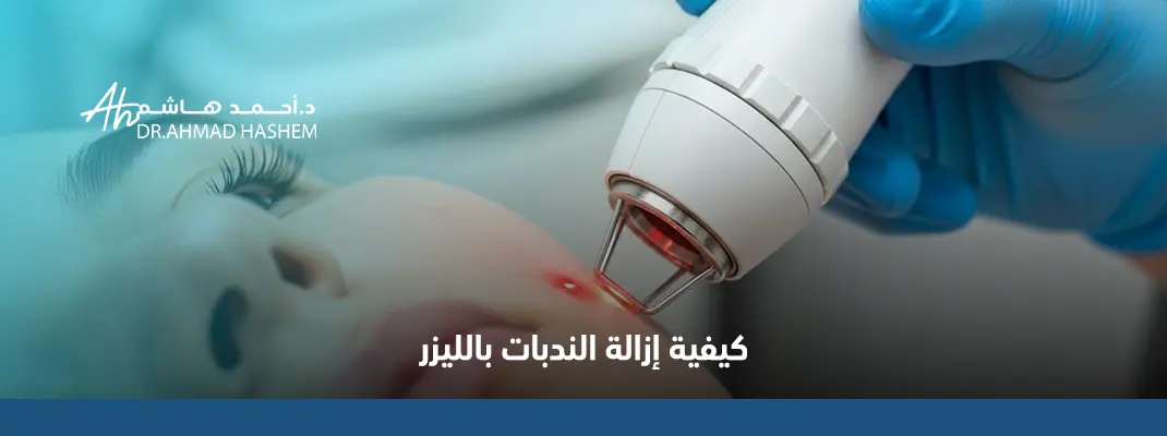 كيفية-إزالة-الندبات-بالليزر.webp
