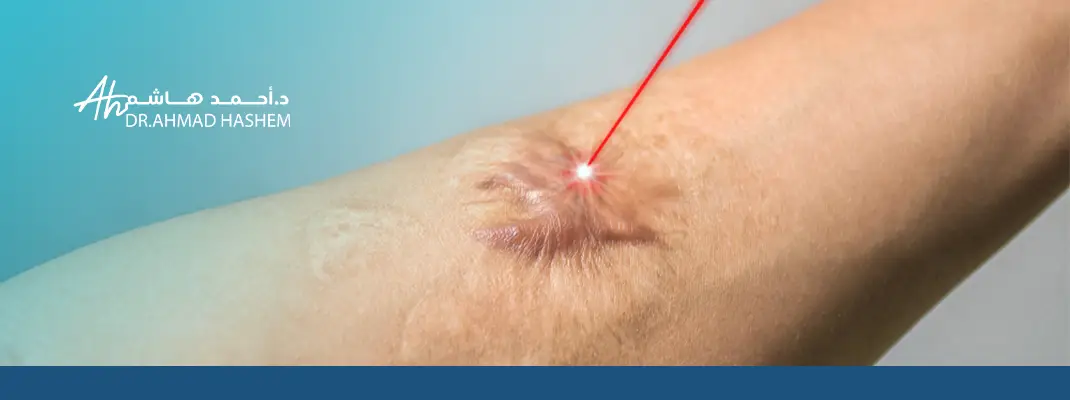 ليزر ازالة الندبات