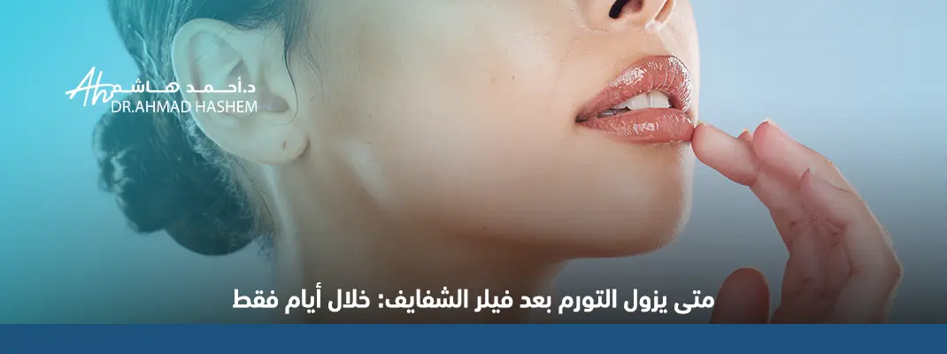 متى يزول التورم بعد فيلر الشفايف