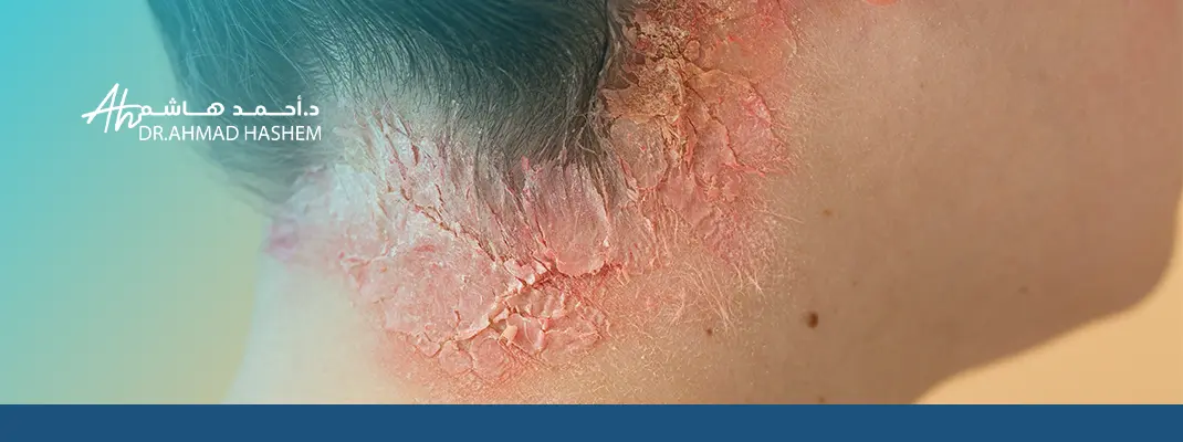 أسباب الأكزيما الدهنية في الوجه