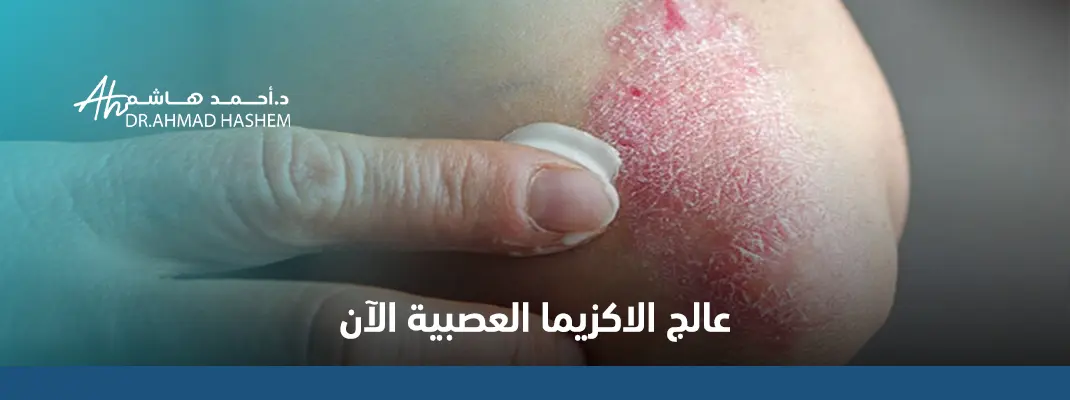 أسباب الإكزيما العصبية