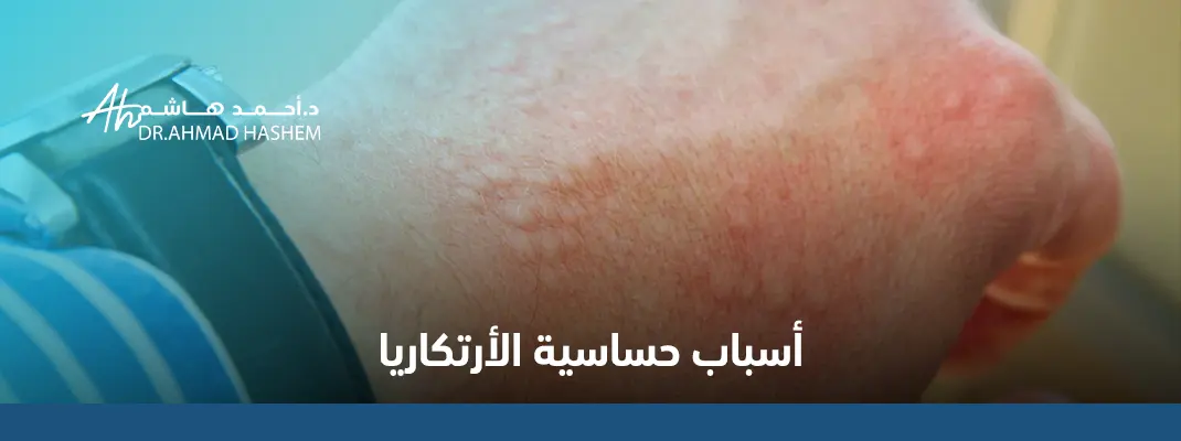 أسباب-حساسية-الأرتكاريا.webp