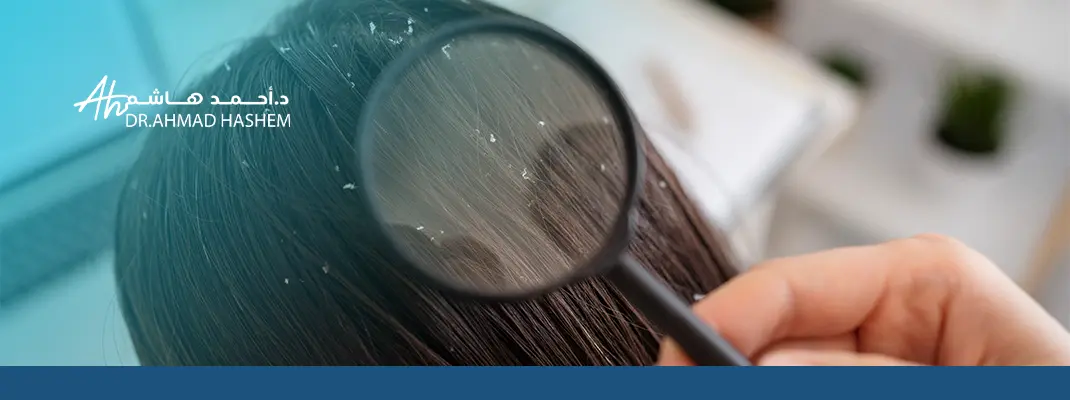 أسباب قشرة الشعر عند النساء