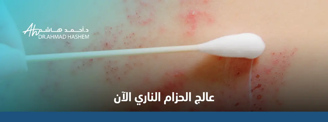 أسرع طريقة لعلاج الحزام الناري