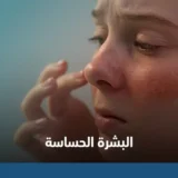 أعراض البشرة الحساسة