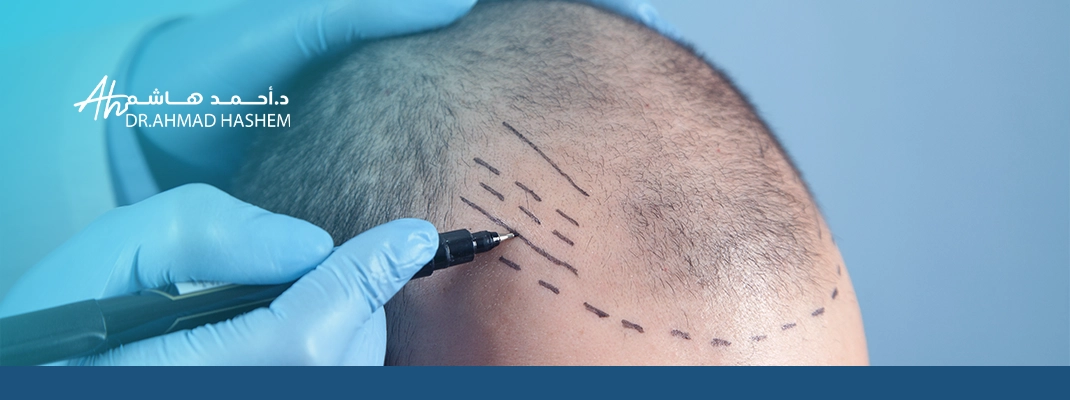 أفضل عيادة زراعة شعر في جدة