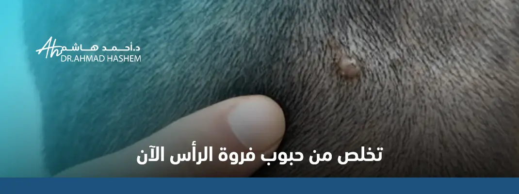 أنواع حبوب فروة الرأس