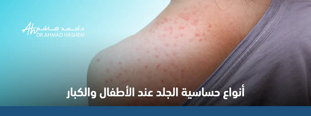 أنواع-حساسية-الجلد-عند-الأطفال-والكبار.webp