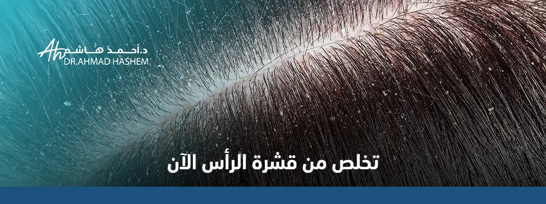 أنواع قشرة الشعر بالصور