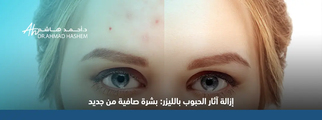ازالة-اثار-الحبوب-بالليزر.webp