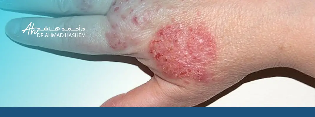 الأكزيما العصبية بالصور