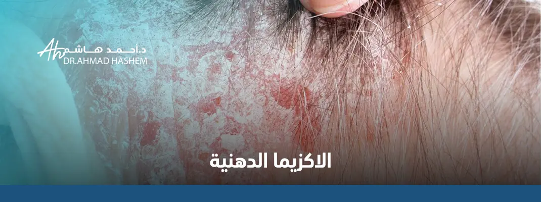 الاكزيما-الدهنية.webp