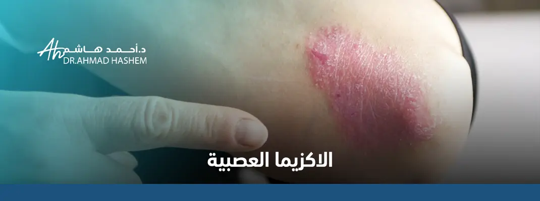 الاكزيما-العصبية.webp