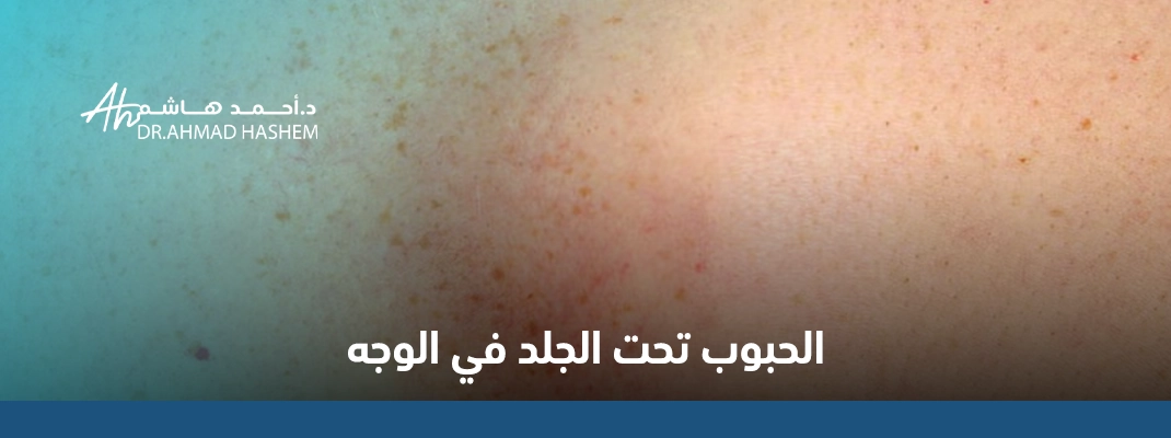 الحبوب-تحت-الجلد-في-الوجه.webp
