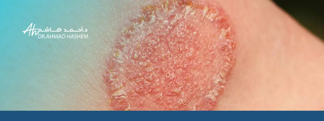 الحل النهائي لفطريات الجلد