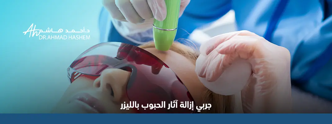 الليزر لازالة اثار الحبوب