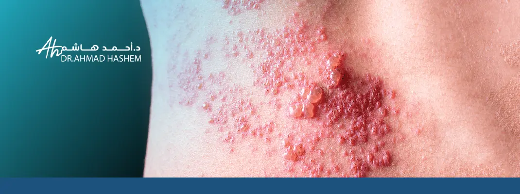 تجربتي في علاج الحزام الناري