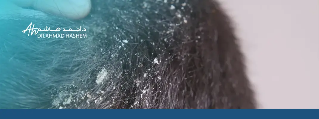 تجربتي مع الأكزيما الدهنية