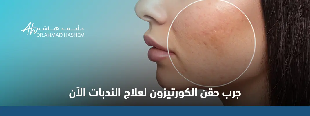 تجربتي مع حقن الكورتيزون للندبات