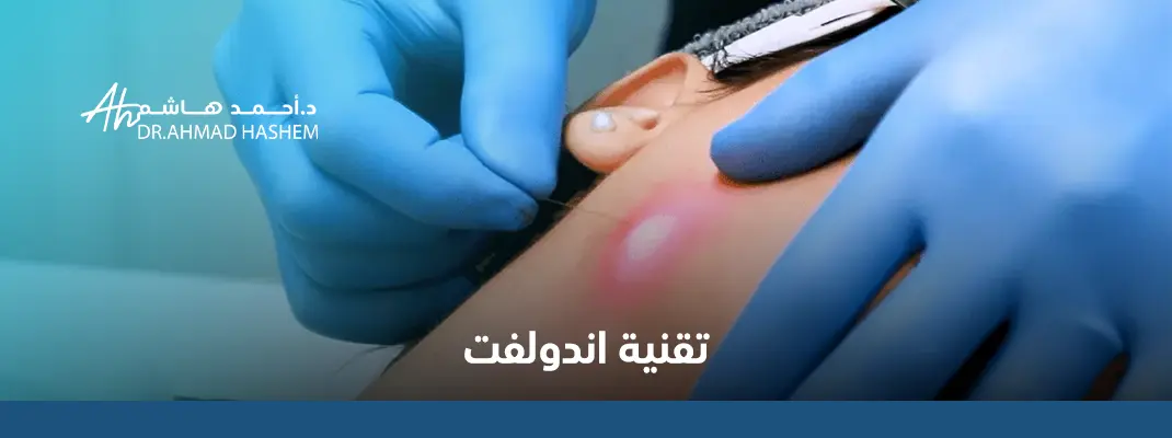 تقنية اندولفت