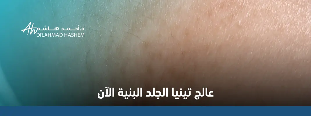 تينيا الجلد البنية بالصور