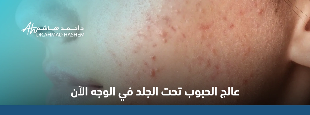حبة تحت الجلد بدون رأس في الوجه