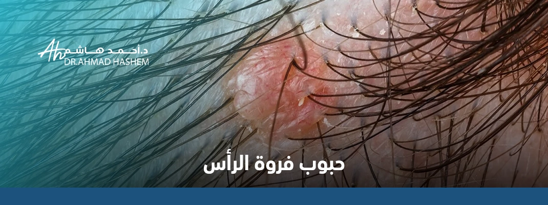 حبوب فروة الراس