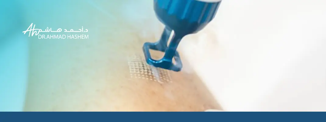 حروق ليزر فراكشنال