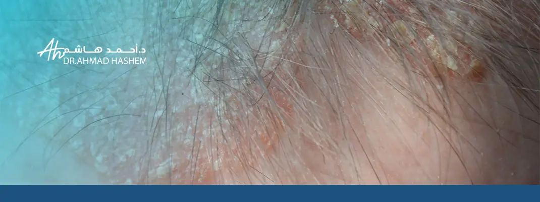 شكل صدفية الشعر