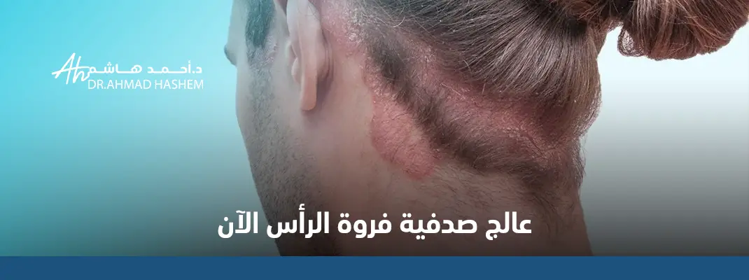 صدفية فروة الرأس بالصور