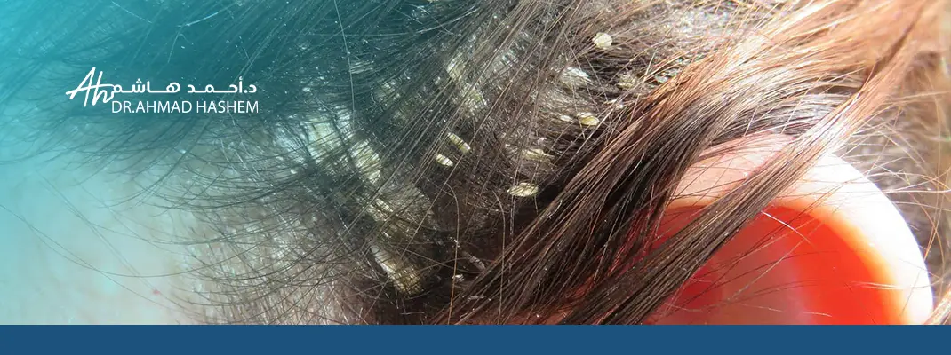 صدفية فروة الرأس وعلاجها