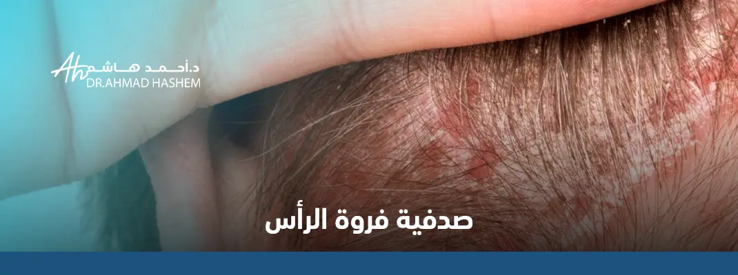 صدفية-فروة-الرأس.webp