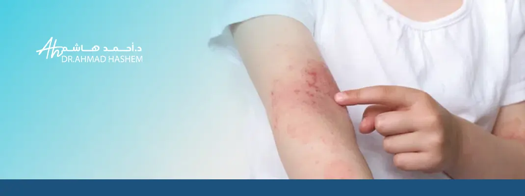 علاج الإكزيما العصبية