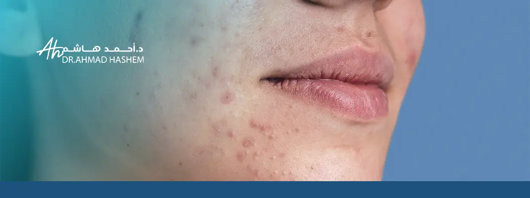 علاج البشرة الدهنية للنساء
