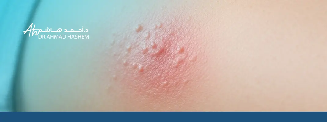 علاج التسلخات في المناطق الحساسة للاطفال