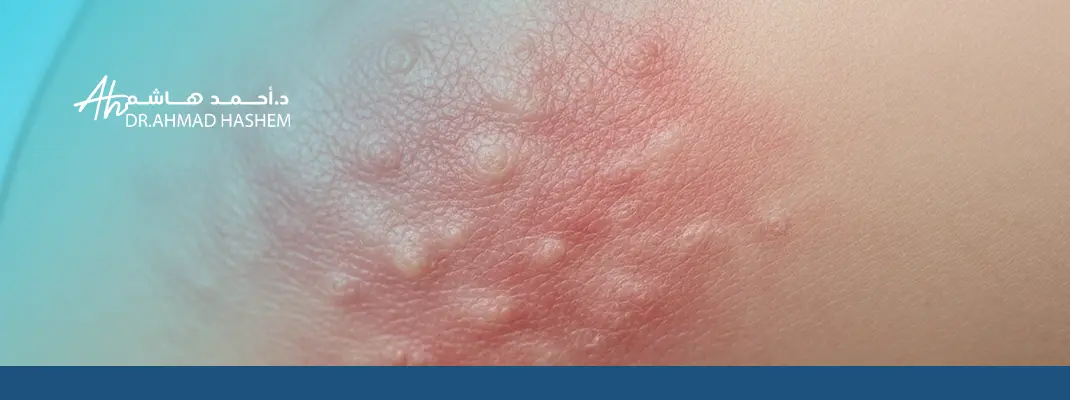 علاج التسلخات في المناطق الحساسة للرجال