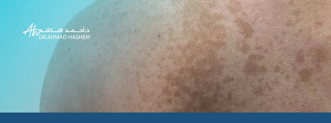 علاج التينيا البنية نهائيا