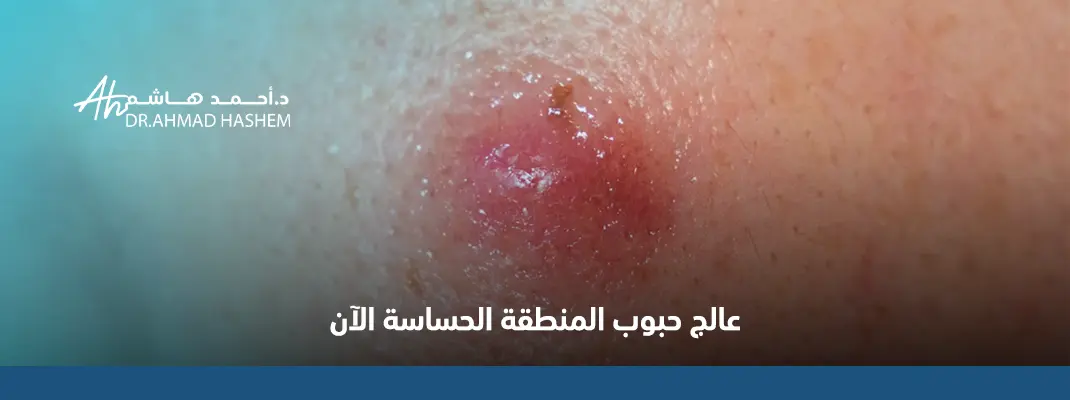 علاج الحبوب في المناطق الحساسة علاج الحبوب في المناطق الحساسة