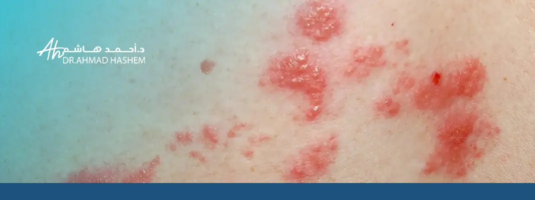 علاج الحزام الناري بالصور