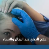 علاج الصلع عند الرجال والنساء