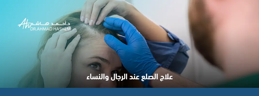 علاج الصلع عند الرجال والنساء