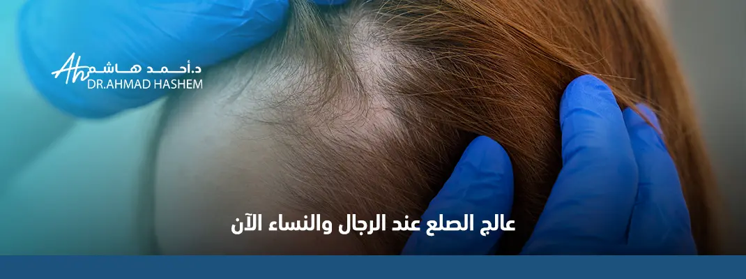 علاج الصلع عند الرجال